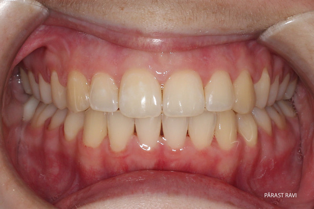 Ortodontilise ravi näide 1. pärast ravi