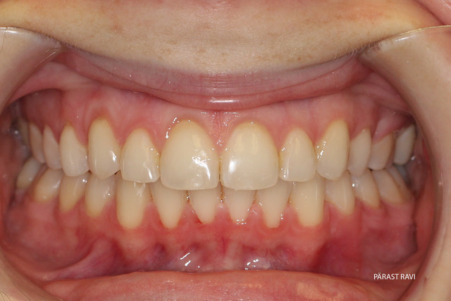 Ortodontiline ravi näide 2 pärast